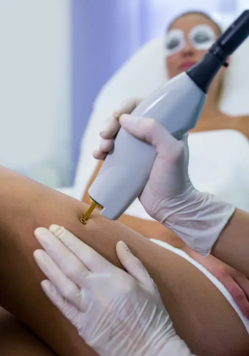 Imagem Laser para tratamento de estrias